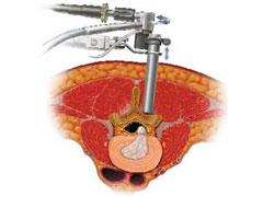 MicroEndoscopic Discectomy (MED)