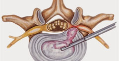 Percutaneous Endoscopic Discectomy (PED)