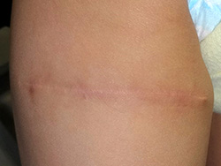 例3 : ほくろが大きい場合は傷跡がある程度目立ちます。最終的には白い線状の跡になります。