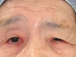 眉毛が下がっています。眉毛の上側の皮膚を引っ張り上げました。
