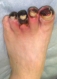 重症下肢虚血(CLI: Critical Ischemia)の患者です。まず血管外科でバイパス手術を行いました。その後、壊死した指のみ切断しました。