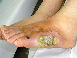 糖尿病性皮膚潰瘍です。壊死組織が付着しています。