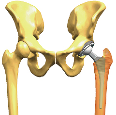 股関節人工関節、手術後のリハビリ